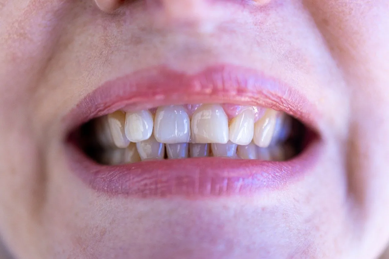 Dix aliments à favoriser pour ne pas avoir de caries