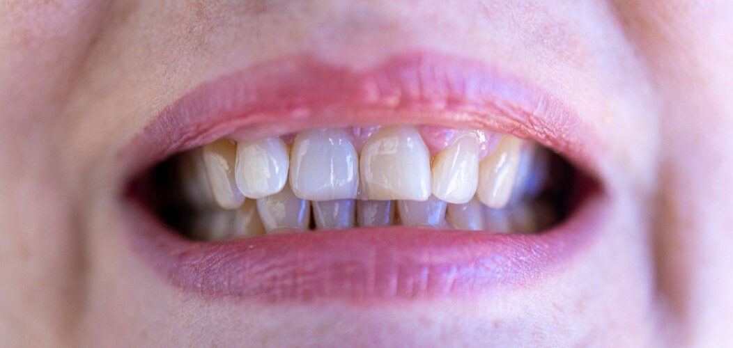 Dix_aliments_à_favoriser_pour_ne_pas_avoir_de_caries