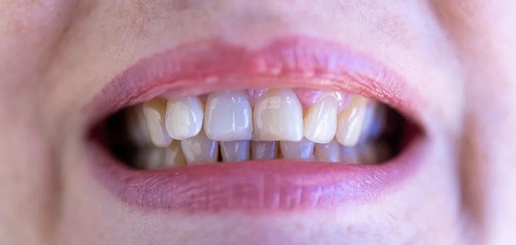 Dix_aliments_à_favoriser_pour_ne_pas_avoir_de_caries